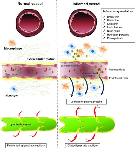 Figure 3 Effect of inflammation on the development of the EPR effect in inflammatory tissue. Inflammatory tissue will release a range of mediators that will induce the EPR effect. Inflammation will cause the vessel to dilate resulting in a higher blood flow. Furthermore, the contraction of endothelial cells will allow the penetration of nanoparticles into the tissue. The major difference between inflammatory tissue and tumor tissues in relation to macromolecular targeting is the presence of a functional lymphatic system in inflammation. Retention of nanomedicine in this case can be attributed to macrophage uptake.Abbreviation: EPR, enhanced permeability and retention.