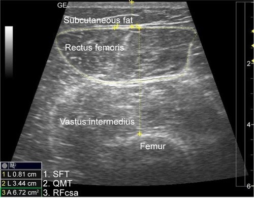 Figure 1 Ultrasonography measurements of the subcutaneous fat thickness (SFT), quadriceps muscle thickness (QMT) and rectus femoris cross-sectional area (RFcsa).