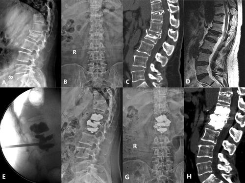 Figure 1. Case 1. A 74-years old female patient complained refractory low back pain after lumbar sprain 90 days ago. A-B: X-ray at admission demonstrated L2 compression fracture with narrowed L1/2 disk space. C: Preoperative CT sagittal reconstruction show L2 collapse and osteophyte formation with upper endplate fracture. D: MRI at admission showed severe compressed and subacute fracture of L2, L1/2 disk space at T2 WI show disk injury with heterogeneous signal. E: Unilateral extra-pedicular PKP was performed at the injured vertebra, fluoroscopy show cement leak into the injured disk after adequate distribution in the L2. F-G, H: Postoperative X-ray and CT sagittal reconstruction show adequate cement distribution in the injured vertebra and disk, the cement bridge is generated between the vertebra and disk..