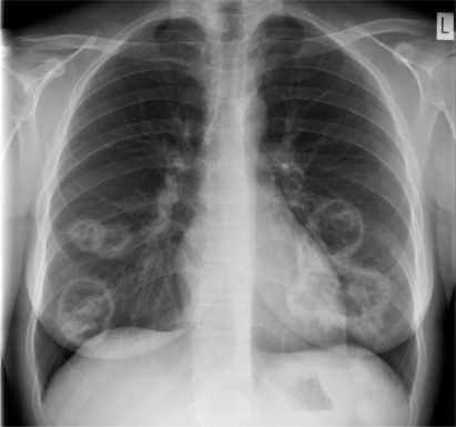 Figure 1 Chest radiograph showing multiple cavitating lung lesions in a patient with Wegener’s granulomatosis.