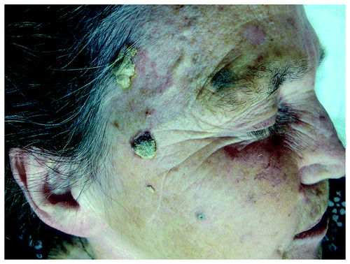 Figure 1. Histologically confirmed hypertrophic actinic keratoses on right facial side of an elderly woman on a background of dermatoheliosis.