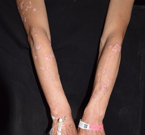 Figure 2 The arms showed generalized with varying sizes and irregularly shaped red maculopapules, plaques, warty hyperplasia, and local surface covered with white adhesive scales, partially accompanied by depigmentation at this visit.