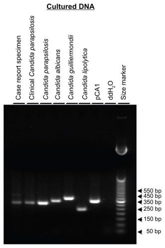 Figure 3 Panfungal polymerase chain reaction analysis.