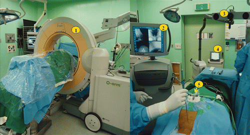 Figure 2. Operating room setting. (1) Intraoperative CT scan being performed with O-arm; (2) navigation monitor; (3) infrared camera system (IFS); (4) NIM (neural integrity monitor); and (5) dynamic reference base (DRB).