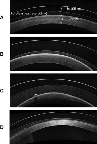 Figure 4 Optical coherence tomography images of the scleral lens, post lens tear reservoir, and cornea. Midday fogging is the accumulation of particulate in the post lens tear reservoir. (A) Minimal particulate is present in the post lens tear reservoir. (B) Dense accumulation of fine particulate is visible in the post lens tear reservoir. (C) Fine particulate and one large globule are present in the post lens tear reservoir. (D) Fine particulate and multiple coalesced collections of particulate are visible in the post lens tear reservoir.