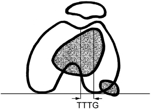 Figure 3. Tibial tuberosity to trochlear groove (TTTG) distance:the distance (in mm) between the most anterior point of the anterior tibial tuberosity and the deepest point of the trochlear groove, measured in 2 superimposed CT images at the level of the proximal tibia and the distal femur.