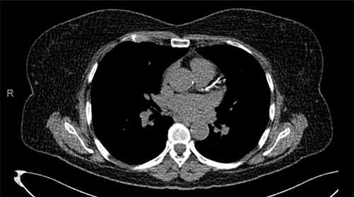 Figure 1 Coronary calcium scan showing diffuse severe coronary calcifications.