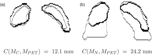 Figure 11. Superimposition of the contours for the same coronal slice in the PET (black contour) and two CTs (grey contour) at two instants in the breathing cycle in patient B: (a) the closest to the PET (MC), and (b) end-inspiration (MN). The criterion C corresponds to the root mean square distance.