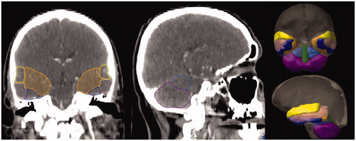 Figure 1. Example case of sublobar brain anatomy delineation: STG (yellow), MTG (pink), ITG (blue), MTL (orange), ACL (light blue), PCL (magenta), and vermis (green).