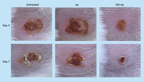 Figure 2.  Methicillin-resistant Staphylococcus aureus-infected full-thickness wounds in mice at days 3 and 7: untreated, treated with empty nanoparticles and treated with nitric oxide nanoparticles.NO: Nitric oxide; np: Nanoparticle.Reproduced with permission from [Citation46]. © Macmillan Publishers Ltd. (2009).
