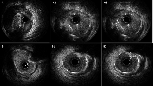 Figure 2 Representative intravascular ultrasound images of tissue protrusion before and after percutaneous coronary intervention. (A) Without calcified lesion before stent implantation; A1: Without calcified tissue intrusion through the stent struts into the lumen; A2: Without calcified tissue protrusion was shown as white dotted line. (B) Calcified lesion before stent implantation, white arrowhead indicate calcified nodule; B1: Calcified tissue intrusion through the stent struts into the lumen; B2: Calcified tissue protrusion was shown as white dotted line.