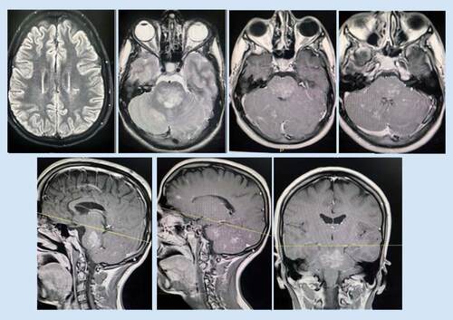 Figure 1. Initial MRI at time of presentation demonstrated multiple ill-defined areas of signal abnormality involving the brainstem, cerebellum and left posterior parietal periventricular white matter (March 2016).They elicit iso to low signal in T1 and high T2/FLAIR signal with patchy postcontrast enhancement. The largest lesion is seen involving the posterior aspect of the brainstem, mainly the pons.