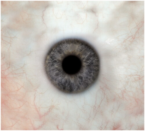 Figure 3. Wide scleral view containing the five merged positions of gaze.