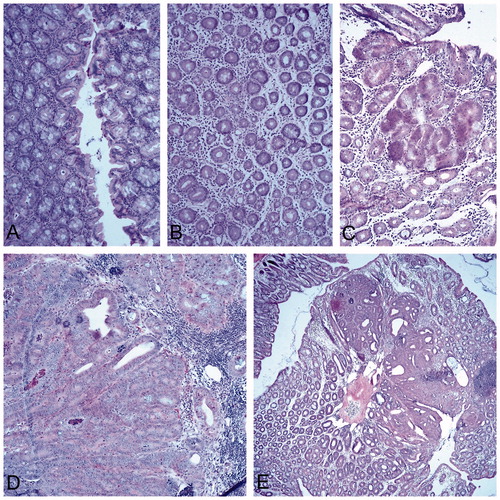 Figure 2. DMH and histological changes in the colon. Representative sections are shown from each group. Representative normal tissues are shown in Figure 1(B). (A) Week 6: weak inflammation, discreet depletion of mucus secretion, cryptic abscesses. (B) Week 12: chronic inflammation, notable edema and depletion of mucosal secretion. (C) Week 24: appearance of dysplastic aberrant crypt foci (center of field), strong depletion of mucosal secretion. (D) Week 30 (six week post-final dose): metaplastic structures and numerous infiltrating lymphoid cells. (E) Week 42 (18 week post-final dose): well differentiated adenocarcinoma of the colon mucosa that corresponds to a typical colon cancer lesion. Magnification =10×; H&E staining.