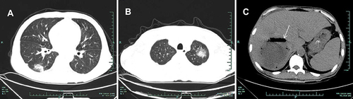 Figure 1 Computed tomographic scans of chest and abdomen. (A) and (B) Both lungs showed small scattered nodules and ground glass opacity. (C) A prominent low-density cystic lesion with gas accumulation (97 mm × 75 mm) in the liver (white arrow), which was considered to be ileus on an abdominal radiograph at the community hospital.