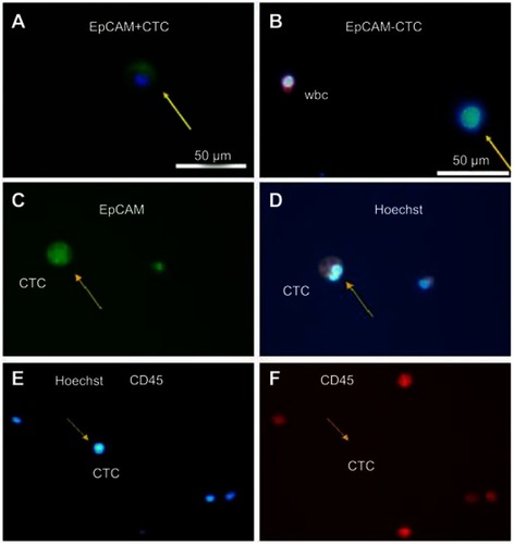 Figure S1 (A) EpCAM+ cells meeting the morphological criteria were identified as CTCs (Hoechst: blue; EpCAM-FITC: green); (B) CD45- cells meeting the morphological criteria were identified as CTCs (Hoechst: blue; CD45-PE: red).