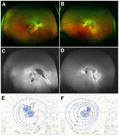 Figure 3 Case 3: (A, B, C, and D) Optomap color imaging (A and B), wide-field FAF (C and D) of the right and left eye, and corresponding visual fields (E and F). In both eyes peripapillary arc-shaped areas of hypofluorescence extending from the central pole, surrounded by hyperfluorescent borders can be seen in Optomap FAF (C and D).