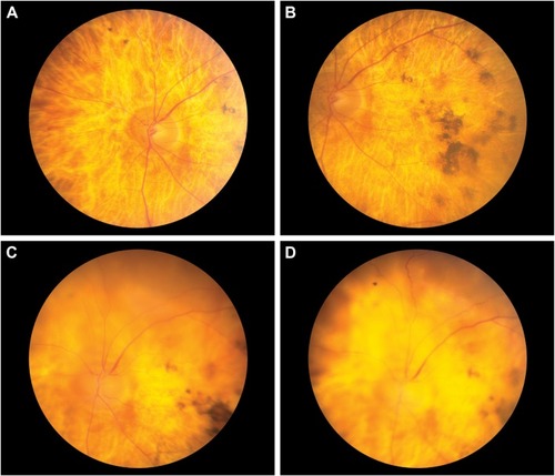 Figure 2 Fundus photographs of the subject’s eye (A, B) before the procedure and (C, D) at 5 weeks after surgery.a
