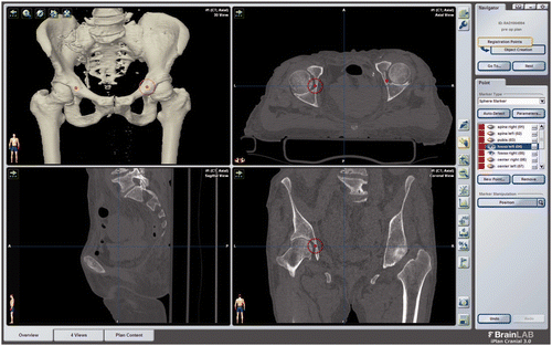 Figure 1. Planning of the pelvic landmarks, including the deepest point in each fossa, performed with iPlan 3.0 software (Brainlab AG).