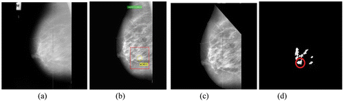 Figure 4. (a) Benign image mdb013 (b) Its preprocessed image with abnormalities recorded (c) With pectoral muscles removed and (d) Segmented ROIs.