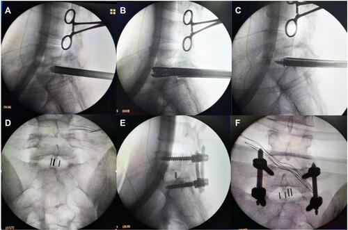Figure 3 Intraoperative C-arm fluoroscopic control. (A–C) Installing expandable tubular, dilating intervertebral space and implanting allograft bone and PEEK cage under the C-arm fluoroscopic control; (D) Lateral X-rays showing satisfactory cage position; (E and F) Anteroposterior and lateral X-rays showing correct implant position.