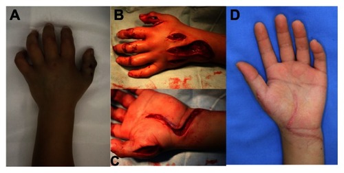 Figure 4 An 8-year-old boy was bitten by a Japanese mamushi on the dorsum of his left thumb (A). Relaxation incision was performed in the lateral side of the thumb, the dorsal hand, and the flexor retinaculum (B and C). He had no complaints 5 months after the snakebite (D).