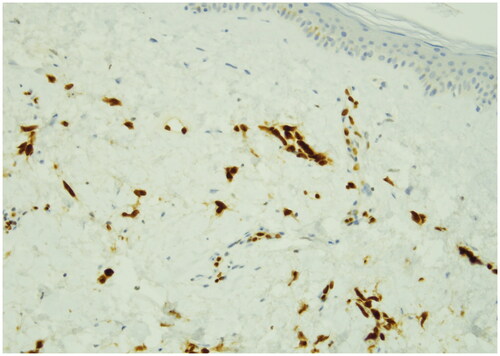 Figure 5. ERG immunostain (40x): strong nuclear expression of neoplastic cells. Transcritional regulator factor (ERG) is a protein encoded by ERG (ETS family transcription factor). ERG is a highly sensitive immunohistochemical marker for vascular differentiation.