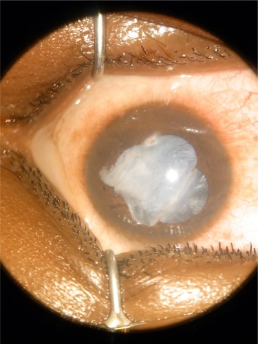 Figure 2 Traumatic cataract.