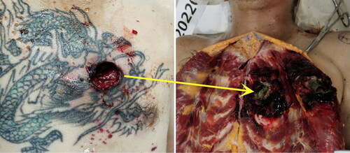 Figure 5. Round laceration wound on the left chest.