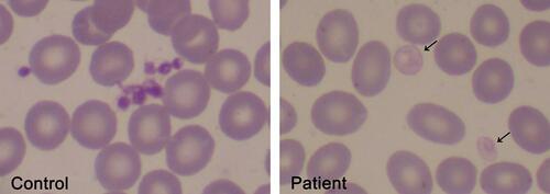 Figure 2 Pale platelets on the blood smear from a GPS patient. Large pale platelets due to absence or marked decrease in α-granules is a typical finding in GPS patients. A May-Grünwald Giemsa-stained blood smear from a GPS patient is shown on the right panel. Gray platelets are indicated by the arrows. A blood smear from a healthy subject stained simultaneously is shown on the left panel. Images were obtained at 1000x magnification.
