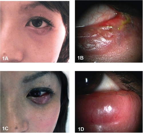 Figure 1 A) Patient with chalazion-like induration of the left lower eyelid on July 11, 2008. B) High magnification of the lower eyelid with chalazion-like presentation. C) After one month, induration of the lower eyelid became rapidly enlarged. Note a diffuse, erythematous, thickened lower eyelid. D) High magnification of the thickened lower eyelid.
