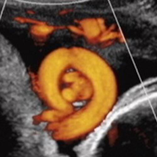 Figure 8 Power Doppler ultrasound image at 36 weeks’ gestation, depicting a co-existing nuchal and true knot of the umbilical cord. Prolonged fetal bradycardia necessitated Cesarean delivery, of a nonhypoxic nonacidotic infant who did well. Note: Reproduced with permission from Sherer DM, Dalloul M, Ward K, et al. Coexisting true umbilical cord knot and nuchal cord: possible cumulative increased risk of adverse perinatal outcome. Ultrasound Obstet Gynecol. 2017;50(3):404–405. Copyright © 2016 ISUOG. Published by John Wiley & Sons Ltd.Citation75