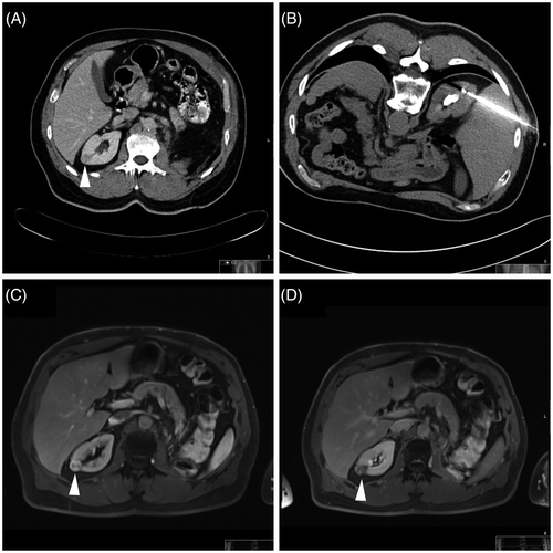 Figure 4. Clinical example. Bipolar RF ablation was performed in a T1a renal cell carcinoma. (A) CT (transverse image) for the diagnosis of an intraparenchymal renal cell carcinoma in the upper segment of the right kidney (white arrowhead). (B) CT (transverse image) for documentation of the applicator (active tip length of 20 mm) – note eccentric applicator position in relation to the tumour centre. (C, D) Dynamic CT (transverse images) 19 months after bipolar RF ablation with evidence of local recurrence – note signs of incomplete tumour destruction with suspect contrast-enhancement (white arrowheads).