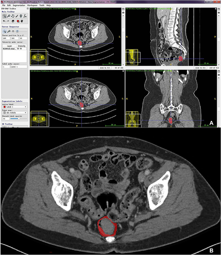 Figure 2 The VOI-t was manually depicted in the itk-SNAP software (A). The VOI-pt was delineated after expanding 5mm from the margin of tumor, automatically (B).