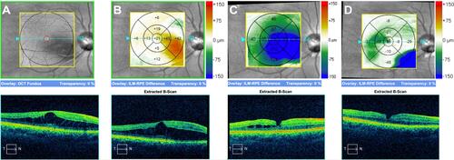 Figure 2 Optical coherence tomography macular change analysis showing structural evolution of the macula (A) at initial presentation, (B) 2 months post-operatively with persistence of macular schisis, (C) 10 months post-operatively with reduction of the intraretinal fluid following adjunctive use of oral spironolactone and topical dorzolamide and (D) 2 years post-operatively with almost complete resolution of the intraretinal fluid following long-term spironolactone use.