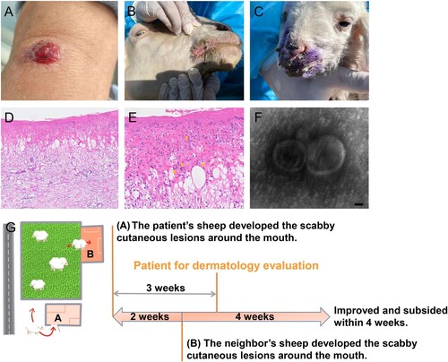 Figure 1. Clinical, histological, TEM findings, and the diagram of the transmission relation chain and course. (A) Physical examination showed central ulceration and a bleeding solitary cutaneous lesion involving the left radiocarpal joint in a diameter of about 1.2 * 0.8 cm with peripheral erythema. (B and C) Similar and typical scabby cutaneous lesions around the mouth in orf virus-infected sheep raised by neighbours were found during further tracking. (D and E) The histological findings displayed partial necrosis, intracellular and intercellular oedema in the epidermis and intraepidermal blistering, diffuse oedema existed in the dermis with dense inflammatory cells infiltration including the neutrophils, lymphocytes and histiocytes into the dermis, also the cytoplasmic eosinophilic inclusion bodies in the epidermis were found. (Haematoxylin-Eosin staining, ×100, ×400). (F) Virus detection by transmission electron microscopy (TEM) analysis at higher magnifications showed typical enveloped virions. Scale bar indicates 50 nm. (G) The three weeks ago when the patient seeking dermatological evaluation, approximately 30 sheep raised by the patient in sheepfold A almost at the same time presented scabby cutaneous lesions around the mouth, also the sheep of neihbours raised in sheepfold B who shared the same pasture also reported an extreme similar history of the sheep presenting cutaneous lesions around the mouth when two weeks after the onset of the lesion in the sheep raised by the patient.