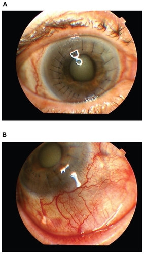 Figure 1 A) Affected eye at presentation with mild corneal edema and fine keratic precipitates. B) Scleritis with scleral thinning and subtenon’s triamcinolone.