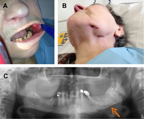 Figure 4 Left mandibular osteomyelitis with bone exposure (A) and sinus tract (B) following left mandibular radiotherapy in a patient receiving long-term bisphosphonate therapy. Panoramic dental X-ray shows mandibular lucencies (C).Note: The arrow shows mandibular lucencies.