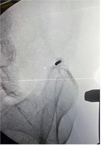 Figure 2 Finder needle placed with fluoroscopy to identify anatomic landmarks (30-degrees).