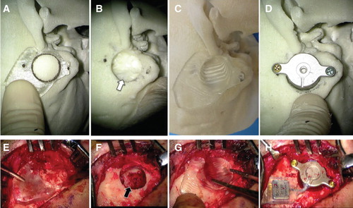 Figure 3. An actual STAMP plate-guided Bonebridge (BB) implantation: (A–D) simulation; (E–H) operation. A temporal bone replica generated from this patient’s CT data was used for this simulation. (A, E) Marking the correct place for BB implantation. The BB-STAMP plate fits only one place on either of the bony surfaces. (B, F) After drilling out of an adequate size of bony hollow. The sigmoid sinus was exposed by the operation (black arrow in F) as was predicted by the simulation (white arrow in B). (C, G) Confirming the hole size and place using the C-STAMP plate. Whether there is enough depth at the right angle can be determined. (D, H) Fixation of the BC-FMT. The transducer fits the hole well and the screw has been fixed to the correct position. BC-FMT, bone conduction-floating mass transducer; C-STAMP, the C-STAMP can check whether the hole is an appropriate size for the BC-FMT.