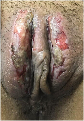 Figure 1. Local skin burns of one patient with VLSC after HIFU treatment.