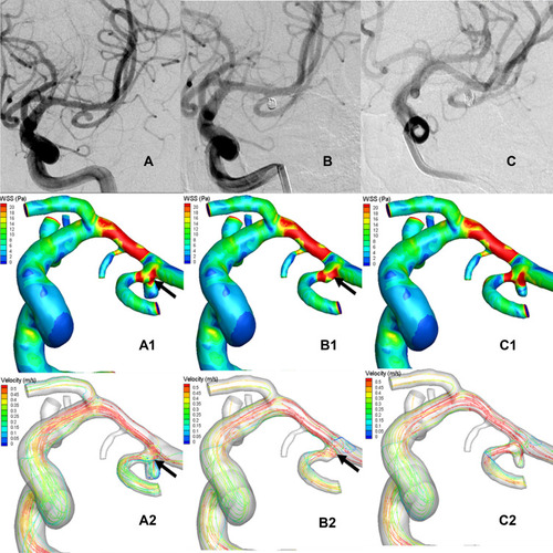 Figure 2 Representative images of a recurrent middle cerebral artery bifurcation aneurysm (MCABA). (A–C) The DSA images were acquired from a 43-years-old woman with a left MCABA. (A) Preoperative DSA revealing a left MCABA. (B) Immediate postoperative DSA revealing the degree of aneurysm embolization reaching the standard of Raymond I (complete occlusion). (C) The follow-up DSA after 6 months revealed that the aneurysm was recurrent. (A1, A2) The hemodynamic analysis preoperatively of the recurrent MCABA. (A1) MWSS was the peak systolic WSS (T = 0.2s). (A2) Flow velocity (T = 0.2s), The blood flow from M1 directly impacted the MCABA sac with relatively high WSS, where two vortexes began to form. Compared with the aneurysmal sac, higher WSS was found at the neck of the MCABA (black arrow shown). (B1, B2) The hemodynamic analysis of immediate post-operative recurrent MCABA. (B1) MWSS. (B2) Flow velocity. The filling material blocked the blood flow from M1 to the aneurysm sac, promoting the streamline to the M2. Compared with the aneurysmal sac, higher WSS was also found at the neck of the recurrent MCABA (black arrow shown, T = 0.2s). MWSS and flow velocity on the aneurysmal neck on the pre-operation are significantly higher than those immediately post-operatively for recurrent MCABA (black arrow showed, T = 0.2s). (C1, C2) The hemodynamic analysis on follow-up of the recurrent MCABA. (C1) MWSS. (C2) Flow velocity. The blood streamlined from M1 flow into a new aneurysm sac formed at the neck of previous aneurysms, where a new complex vortex began to form (T = 0.2s).