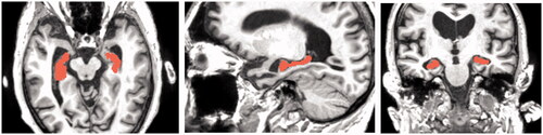 Figure 8. Data process using the Paint Effect tool. The brown area is the highlighted hippocampus.