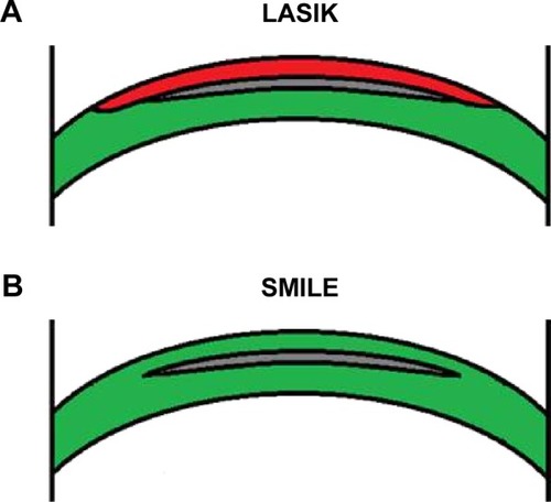 Figure 3 Comparison of LASIK flap (A) and SMILE cap (B). The anterior stroma is relatively stronger in SMILE.