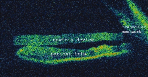 Figure 3 Anterior chamber optical coherence tomography. The lens is positioned over the iris and is in contact with all the 360° coneoescleral trabecular meshwork.