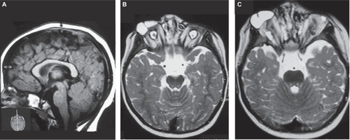 Figure 7 A–C Magnetic resonance imaging of the brain (7A) and of the orbits (7B–C) of case 2.