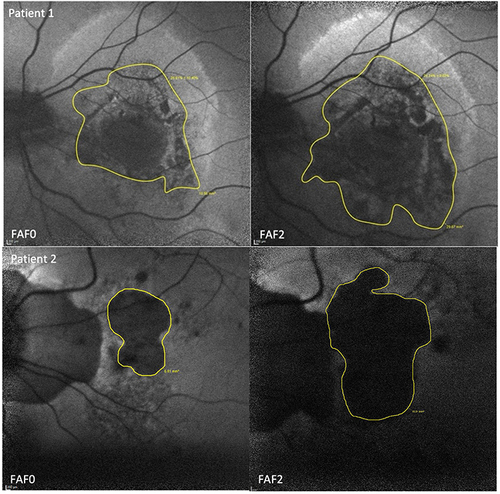 Figure 2 FAF images of two illustrative example patients from our cohort. FAF area at baseline (FAF0) and at the last visit (FAF2).