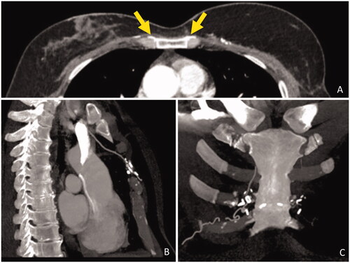 Figure 3. Postoperative CT scan. (A) Axial view, contrast enhancing shows DIEP vessels crossing the sternum (yellow arrows). (B) Sagittal view, IM vessels anastomosed to presternal vessels. (C) Coronal view, microvascular staples highlight the DIEP vessels path through the midline.