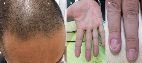 Figure 3 Complete healing after one injection of ustekinumab in the frontal scalp region (A), palms (B), and fingernails (C).