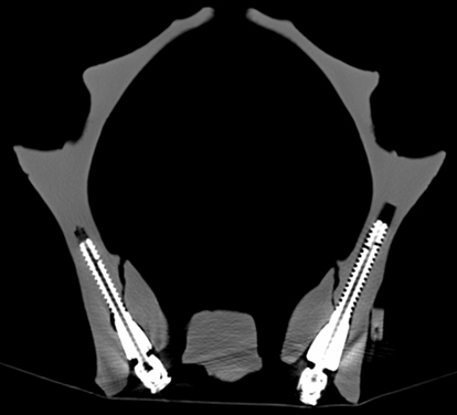 Figure 4 Iliac screws with a screw length of 40 mm (left side) or 50 mm (right side) fix the patient-specific implants on both sides. The anatomical conditions with a flat surface on the iliac side and a concave surface on the sacral side determine the chirality of the customized implants (solid plastic model).